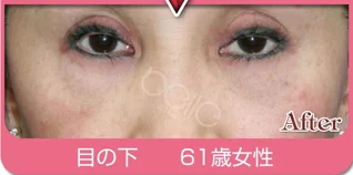 FGFの施術例:施術例３(施術後)