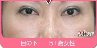 FGFの施術例:施術例４(施術後)