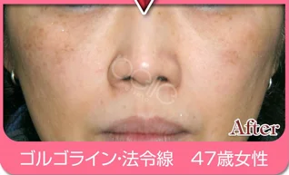FGFの施術例:施術例５(施術後)