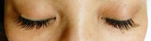 Cカール8～10～11㎜の施術後