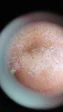 毛穴洗浄でスッキリ！の施術前