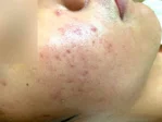 メンズハーブピーリングの施術前