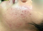 メンズハーブピーリングの施術前