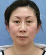 施術例１の施術前